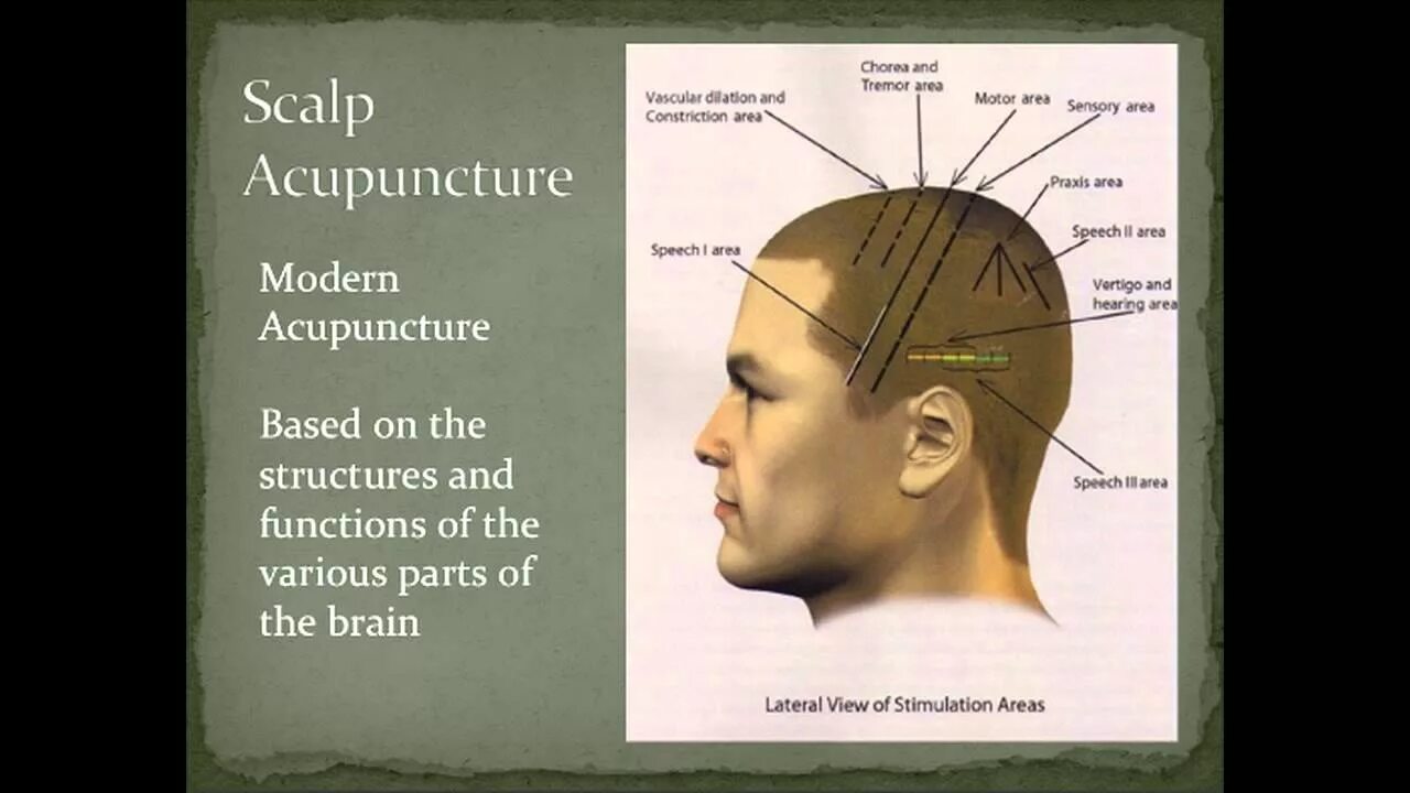 Скальп акупунктура. Zhus Scalp Acupuncture. Краниопунктура воздействие на зоны головы. Scalp перевод