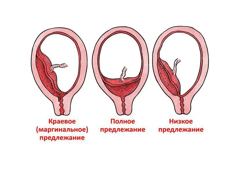 Близко расположена матка