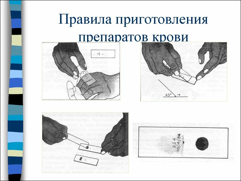 Для диагностики малярии забор крови осуществляют. Мазок и толстая капля крови на малярию. Приготовление толстой капли крови. Забор крови на малярию алгоритм. Приготовление мазка крови.