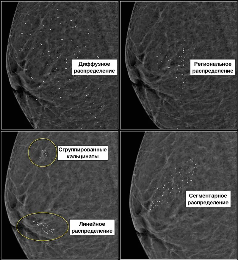 Микрокальцинаты в молочной железе на маммографии. Маммография кальцинаты доброкачественные. Маммография bi-rads 2. Микрокальцинаты на УЗИ молочных желез. Маммография периодичность