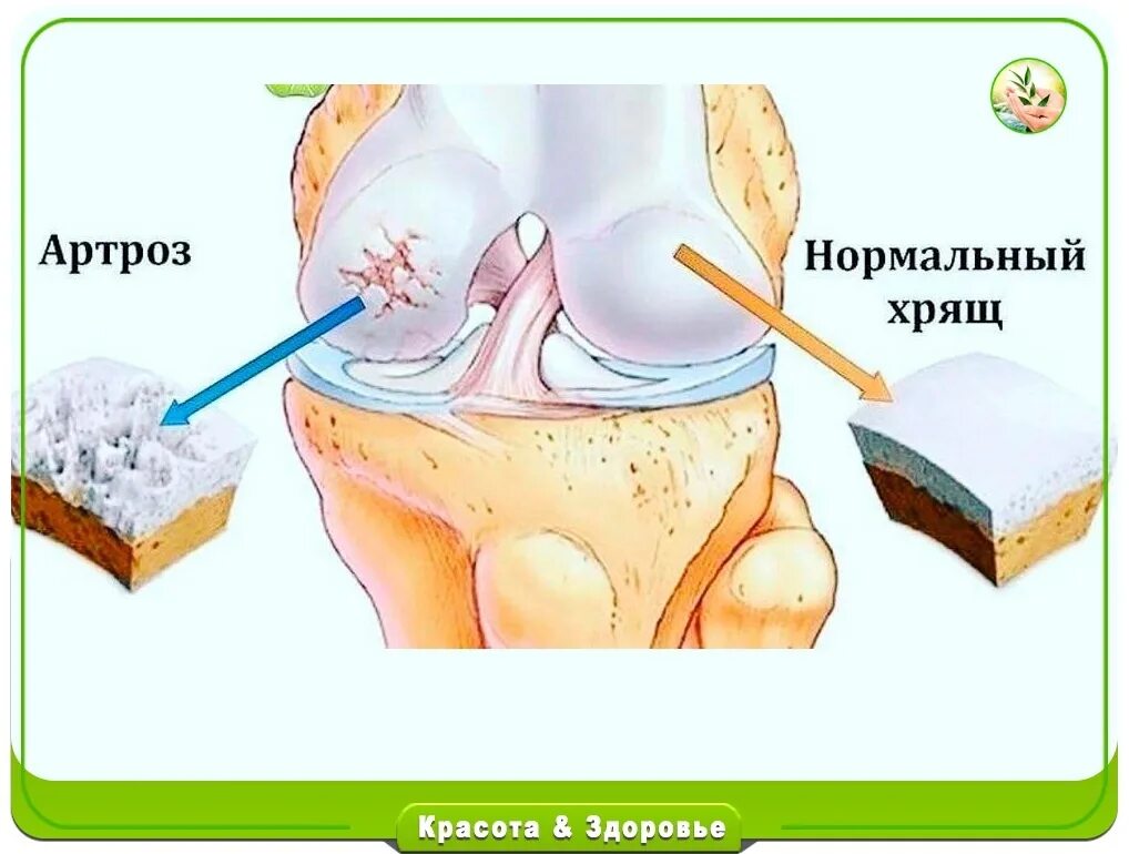 Как нарастить хрящевую ткань в суставах