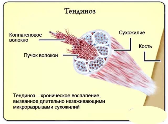 Образует связки сухожилия дерму. Воспаление ткани сухожилия. тендинопатия сухожилия.