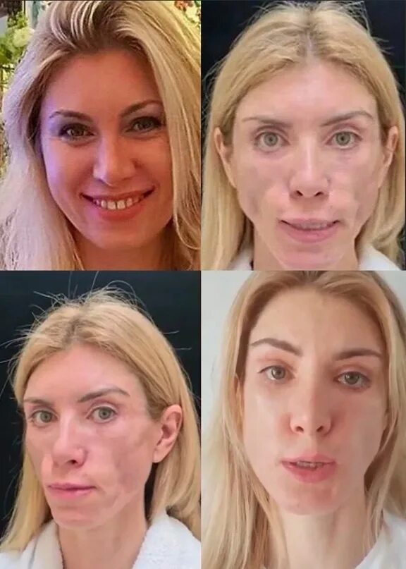 Юля после пластики