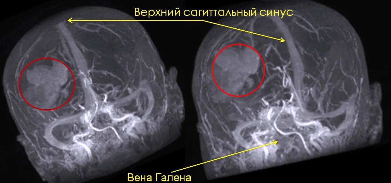 Сколько живут с доброкачественной опухолью головного мозга. Опухоль в синусе головного мозга. новообразования в лобной части головы. опухоль головного мозга в лобной части. опухоль головного мозга в лобной части головы.