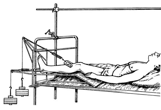Скелетное вытяжение при переломе вертельной зоны бедра. Шина Беллера для скелетного вытяжения. Перелом шейки бедра скелетное вытяжение. Скелетное вытяжение бедренной кости техника.