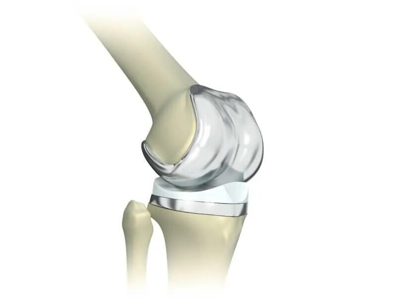 Эндопротез Зиммер коленного сустава е3. Операция тотального эндопротезирования коленного сустава. Эндопротез с подвижной платформой. Протезы для эндопротезирования коленного сустава. Операция по замене коленного сустава москва