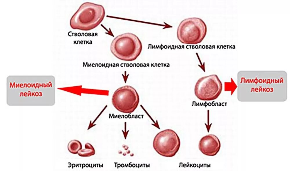Стадии развития крови. Острый миелобластный лейкоз схема. Острый миелобластный лейкоз картина крови. Лимфоидная стволовая клетка. Острый миелоцитарный лейкоз.