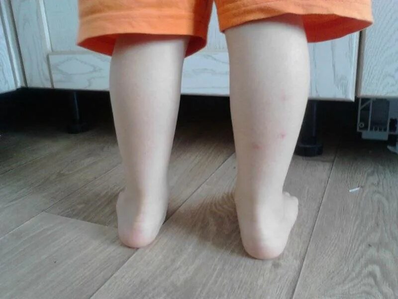 Ребенку год стал ходить на носочках. Идиопатическая ходьба на носках. Последствия хождения на носочках. Ходьба на носочках у детей. Ребенок 5 лет ходит на носочках.