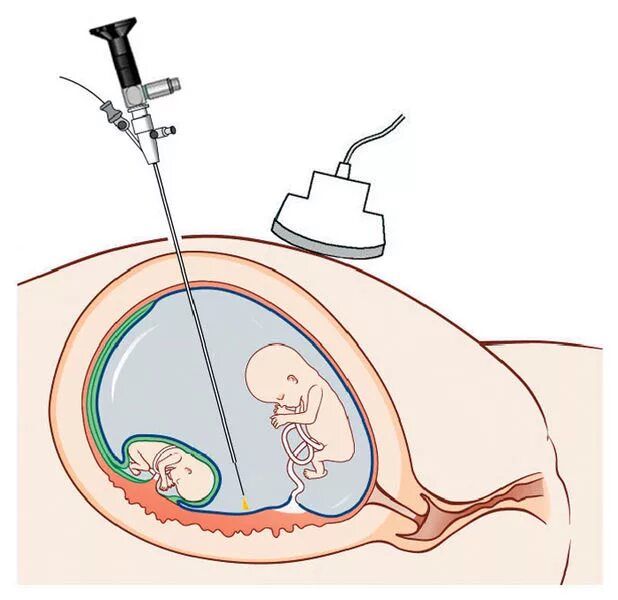 Фетоскопическая коагуляция пуповины. Фетоскопическая лазерная коагуляция сосудистых анастомозов. Фетоскопическая коагуляция анастомозов плаценты. Кордоцентез фетоскопия.