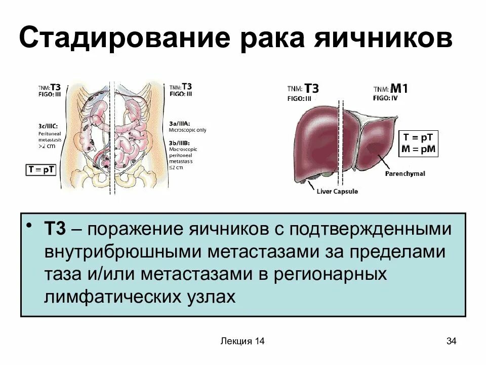 Метастатические опухоли яичника. Опухоль яичника метастазы. Регионарные лимфоузлы яичника. Рак яичников 1 стадия