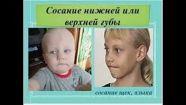 Лет сосание. Сосание нижней губы вредная привычка. Закусывание нижней губы у детей. Привычка сосания верхней губы. Ребенок прикусывает нижнюю губу.