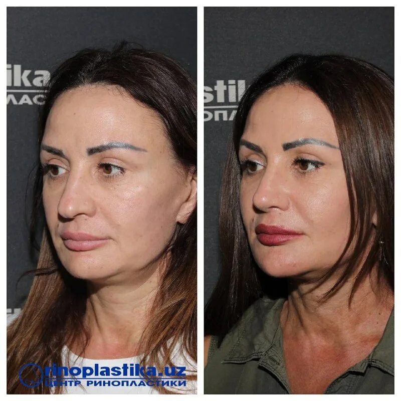 центр ринопластики