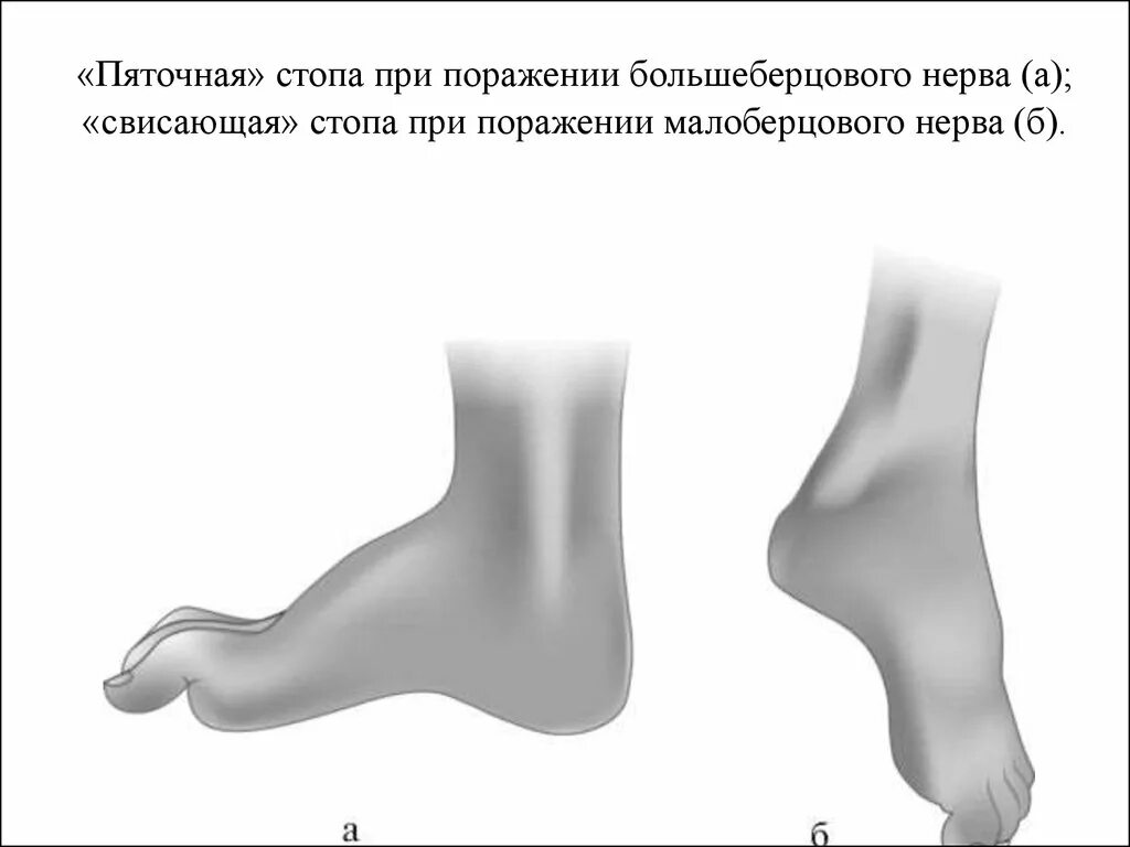 Большеберцовая нейропатия. Повреждение поверхностного малоберцового нерва. Невропатия большеберцового нерва. Невропатия малоберцового и большеберцового нерва. Поражение большеберцового и малоберцового нерва.