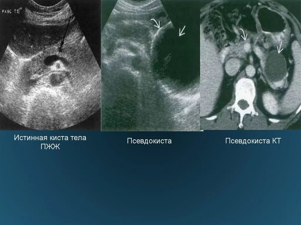 Как отличить кисту. Псевдокиста поджелудочной железы кт. Псевдокисты поджелудочной железы на кт. Псевдокиста поджелудочной железы на УЗИ.