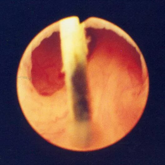 Врожденные задние уретральные клапаны. Врожденные клапаны мочеиспускательного канала. Клапан задней уретры уретроскопия. Клапан задней уретры у детей.