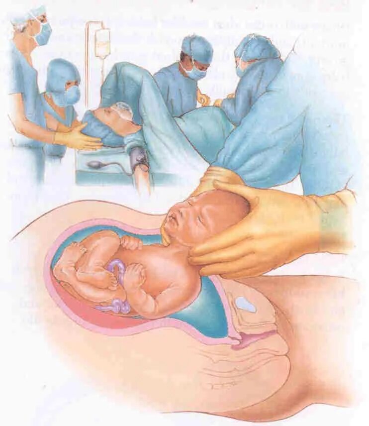 После первого рода. Операция кесарево Сечени. Рождение ребенка кесарево сечение.