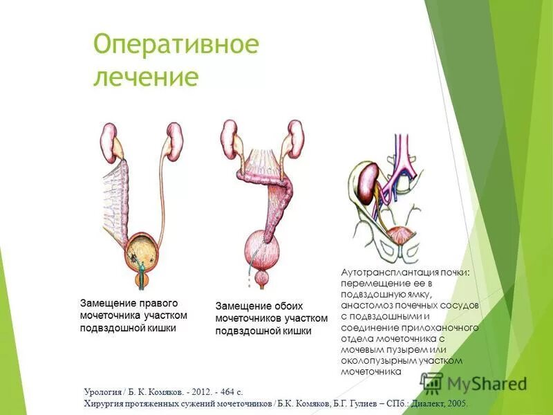 Изгибы мочеточника. Перегиб мочеточника в верхней трети. S образный изгиб мочеточника. S образный Перегиб мочеточника.