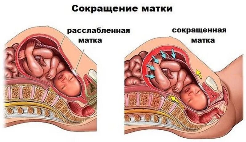 Гипертонус Матки Можно Заниматься Сексом
