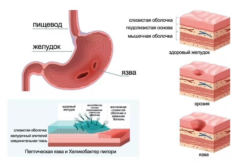 Боли при гастрите и язве. Язвенная болезнь желудка ,эпителизация. эпителизация язвы желудка что это такое. язвенная болезнь желудка форма поражения. строение стенки язвы желудка.