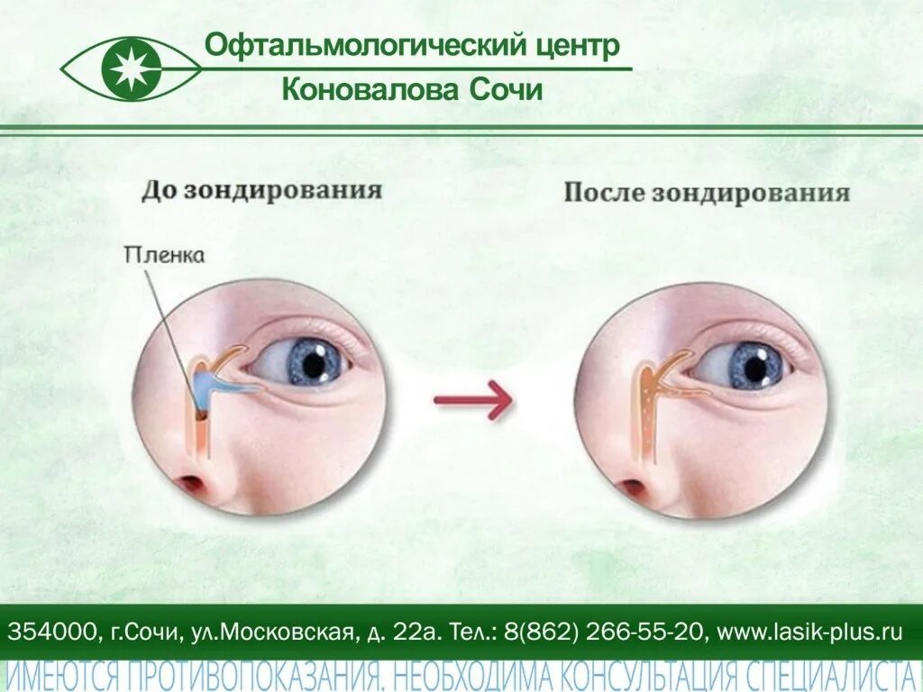 Зондирование младенцев