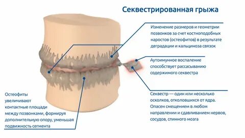 Можно ли после операции грыжи