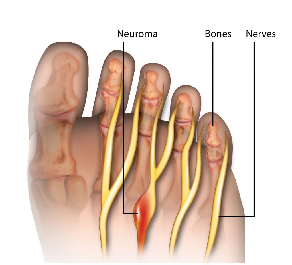 Невринома Мортона синдром. Межпальцевая неврома Мортона. Невринома Мортона стопы. Неврома Мортона мизинец. Нейрома