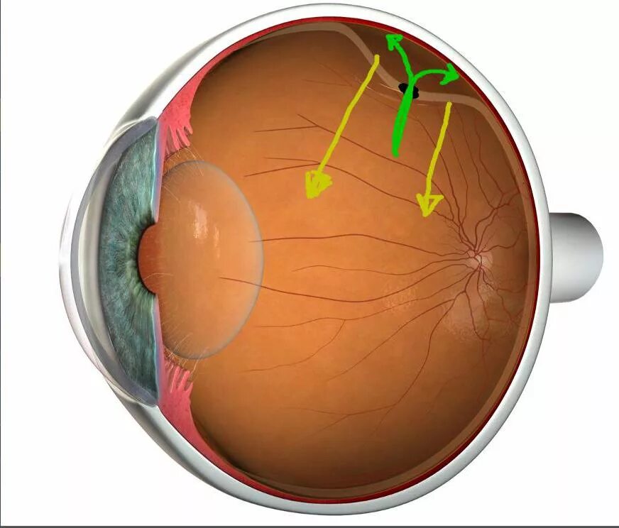 Анатомия глаза отслойка сетчатки. Травматическое отслоение сетчатки. Сетчатка глаза строение отслоение. Клапанный разрыв сетчатки. Повреждение сетчатки