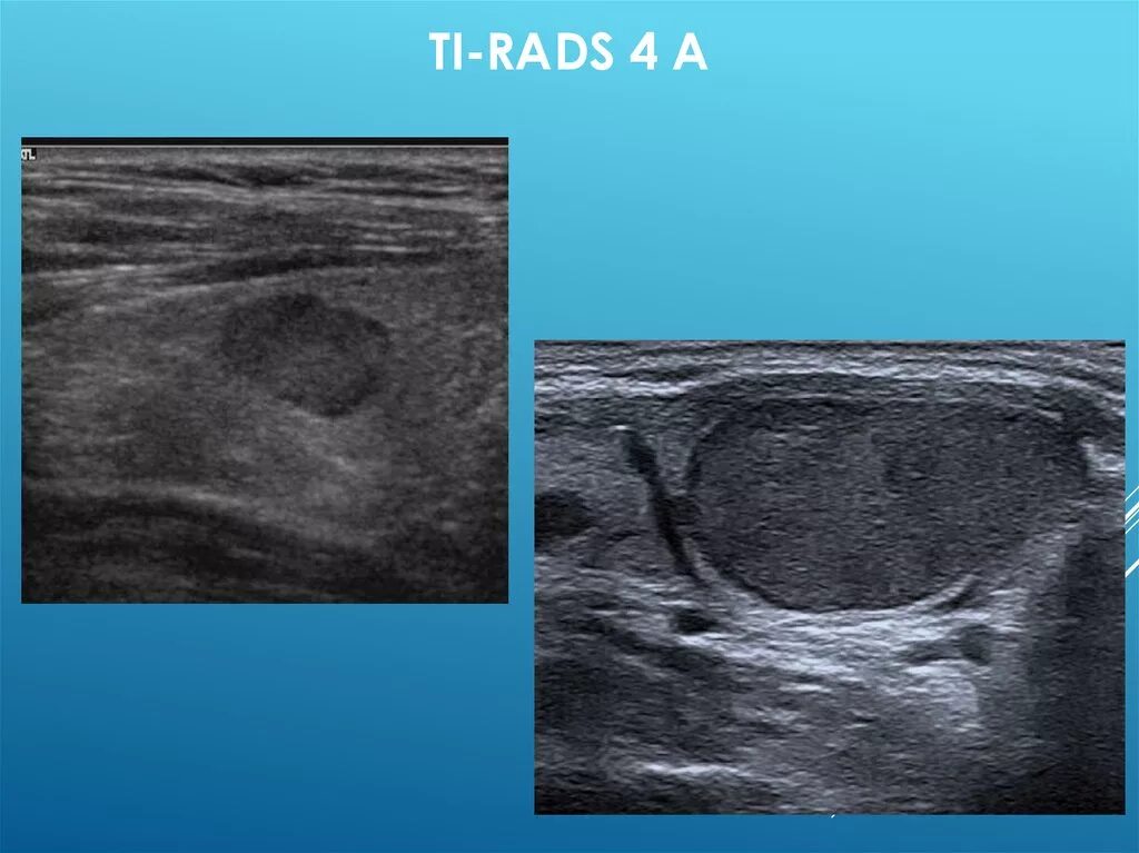 Ti rads узи. Тирадс 5 щитовидной железы УЗИ. Ti- rads 3 на УЗИ щитовидной железы. Тирадс 4 щитовидной железы УЗИ. Ti-rads 4b.