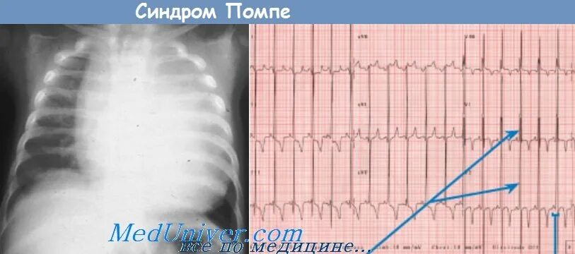 Болезнь помпе у детей. Болезнь помпе картинки. синдром андерсена-тавила.