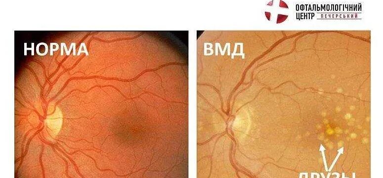 Макулодистрофия друзы. Макулодистрофия друзы. Макула дистрофия сетчатки глаза. Макулярная дистрофия сетчатки глаза. Хориоретинальная дистрофия сетчатки.