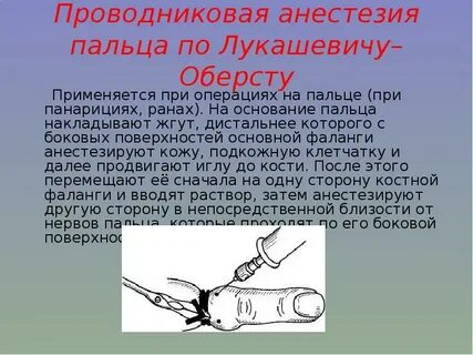 Анестезия по лукашевичу оберсту