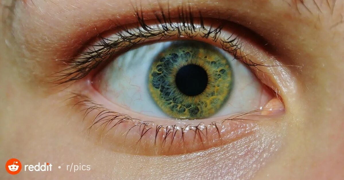 Цвет глаз человека определяется пигментацией. Пигмент в радужной оболочке. Цвет глаз у альбиносов. Пигментация на радужке глаза.