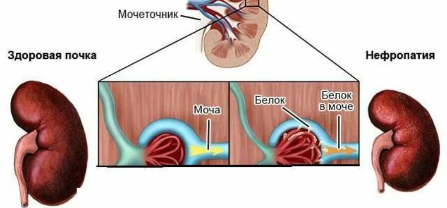 Отеки и белок в моче. Белок в моче. Отеки давление белок в моче при беременности. Отёки и белок в моче при беременности.