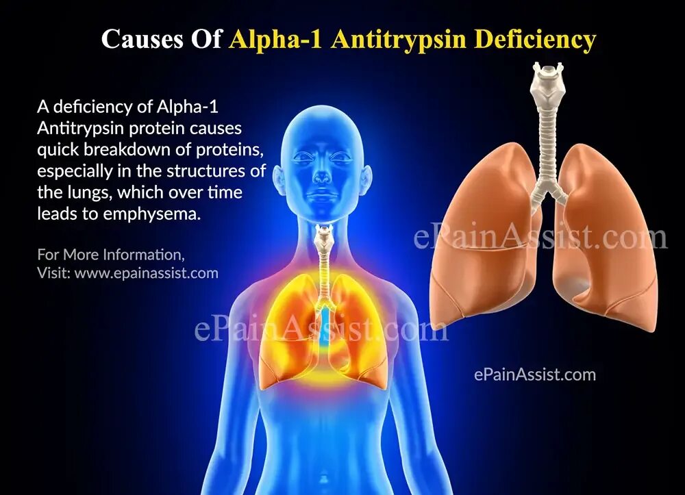 Α1-антитрипсин. Альфа антитрипсин. Альфа 1 антитрипсин эмфизема. Alpha antitrypsin deficiency. Alfa is