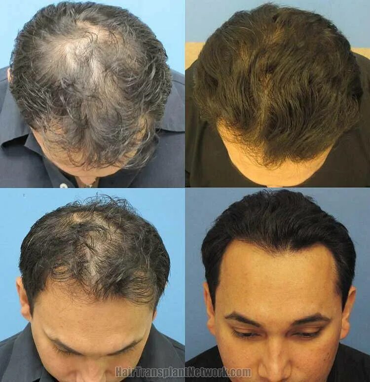 Волосы у мужчин на голове. Залысины от выпадения волос. Выпадают волосы после пересадки