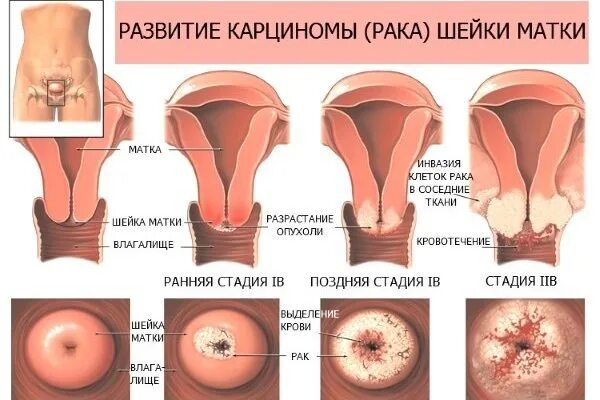 Опухоль шейки матки симптомы. Новообразование на шейке матки.