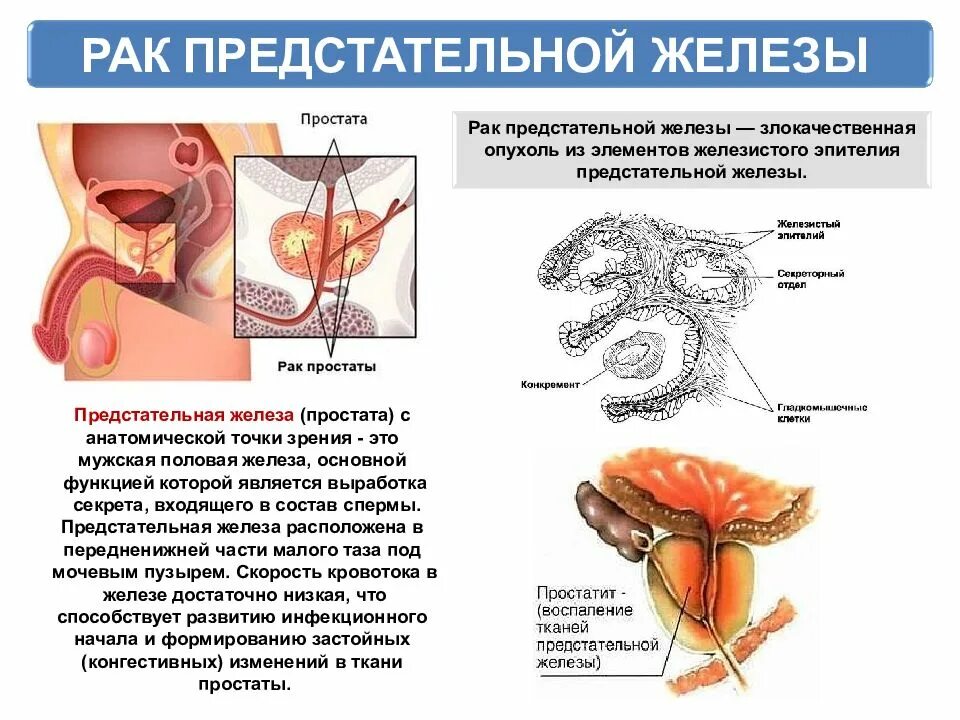 Простата рак симптомы лечение. ОПК предстательной железы. Злокачественное новообразование предстательной железы. Аденома простаты схема. Простата и предстательная железа.