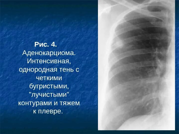 Солидный узел в легких. Образование с лучистыми контурами в легких. Бугристый контур легких. Образование в легком с четкими контурами. Гомогенные очаговые тени.