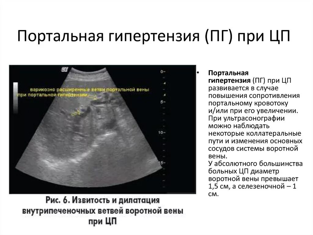 Расширение селезеночных вен. Клинические симптомы портальной гипертензии. Внутрипеченочная портальная гипертензия. Гипертензия портальная к76.6. Эндосонография портальная гипертензия.