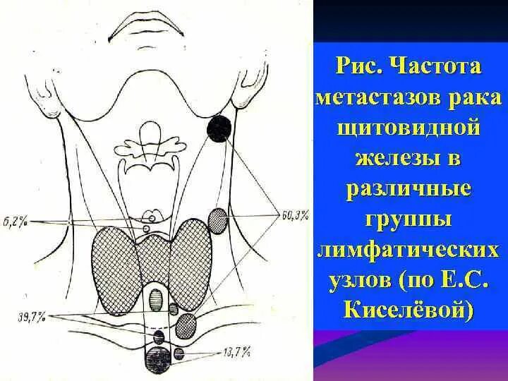 Метастазы при раке щитовидной железы. Регионарные лимфатические узлы щитовидной железы. Лимфатическая система щитовидной железы анатомия. Регионарные лимфатические узлы щитовидной железы на УЗИ. Лимфоузлы в области щитовидной железы.