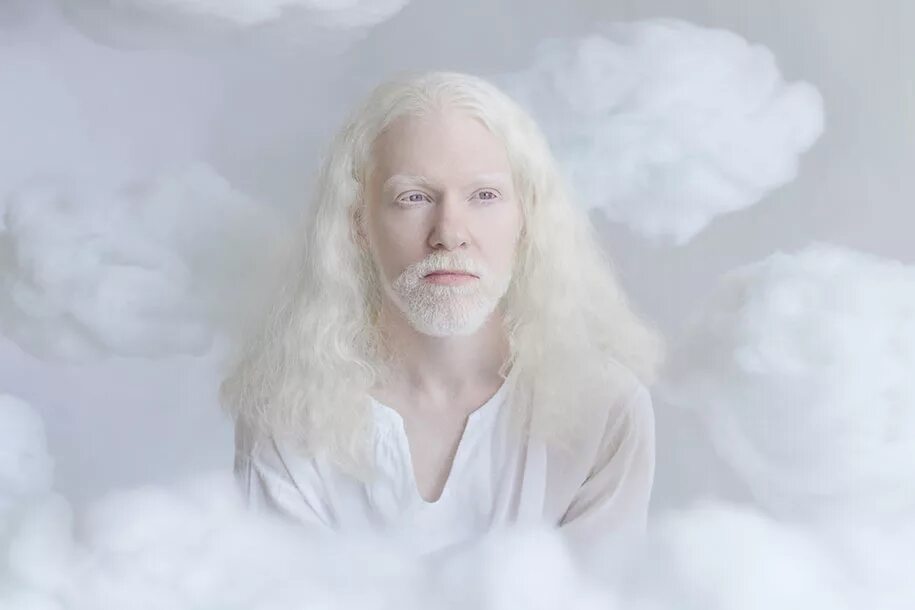 Страдающий альбинизмом. Саша Смирнов альбинос.