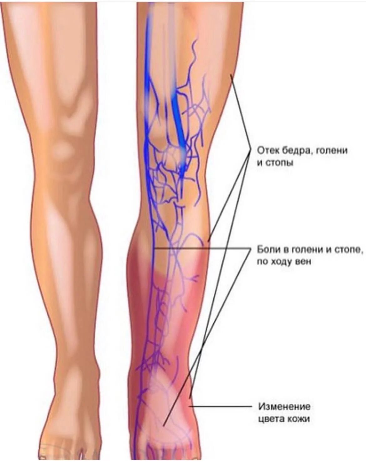 Варикозное расширение вен нижних конечностей БПВ. Тромбофлебит нижних конечностей ног. Острый тромбофлебит вены нижних конечностей. Тромбоз вен нижних конечностей схема. Тромб в артерии симптомы