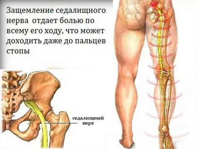 При защемлении нерва можно греть. Защемление седалищного нерва невролог. Седалищный нерв анатомия схема. Кеторол седалищный нерв. От чего защемляется седалищный нерв.