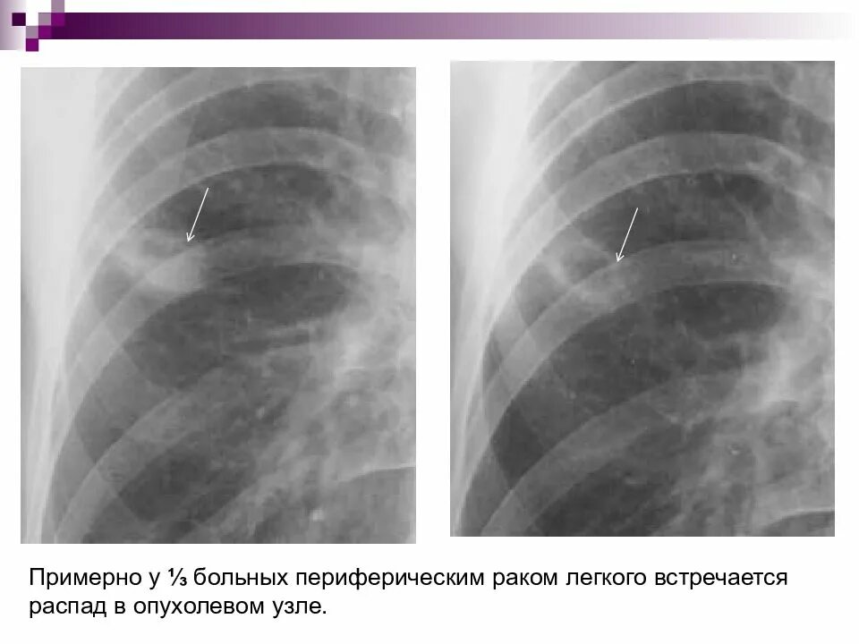 Периферическое образование левого легкого. Периферический РК легкого ренгтнг. Периферический ра легкого рентег. Периферическая опухоль верхней доли правого легкого. Периферическая опухоль легкого s1.