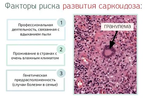 Болезнь легких саркоидоз