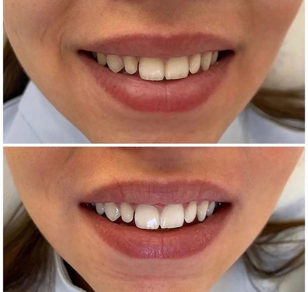 Отбеливание калининград. Отбеливание калининград. Отбеливание полости рта. Домашнее отбеливание. Отбеливание калининград.