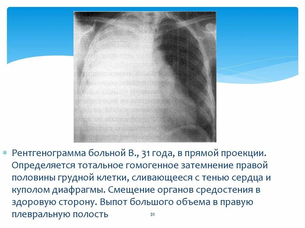 Смещение органов средостения в здоровую сторону. Смещение средостения. Пиопневмоторакс у детей. Смещение средостения на рентгене. Тотальное затемнение легкого со смещением средостения.