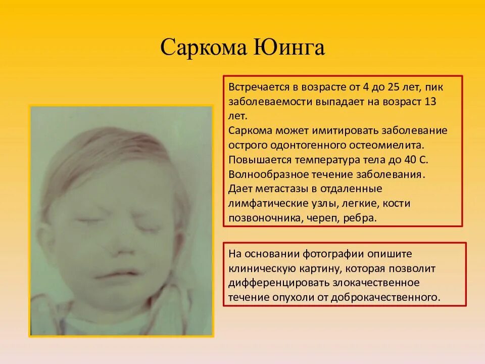 Саркома мягких тканей у детей. Саркома выживаемость. Остеосаркома прогноз жизни. Саркома мягких тканей у детей. Саркома выживаемость.