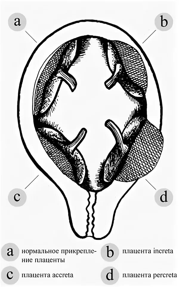 Истинное приращение. Аномалии врастания плаценты. Врастание и прорастание плаценты. Истинное врастание плаценты.