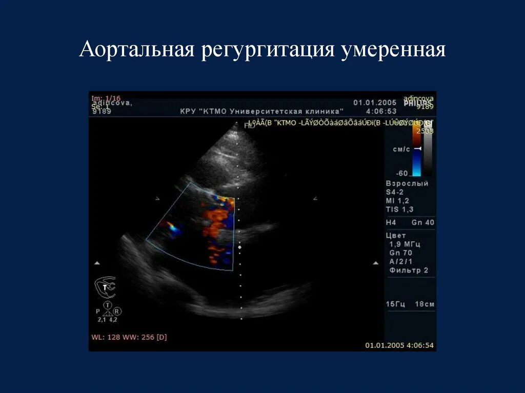 Регургитация на ЭХОКГ. ЭХОКГ аортальный клапан регургитация. Митральная и аортальная регургитация. Симптом Хилла аортальная регургитация.